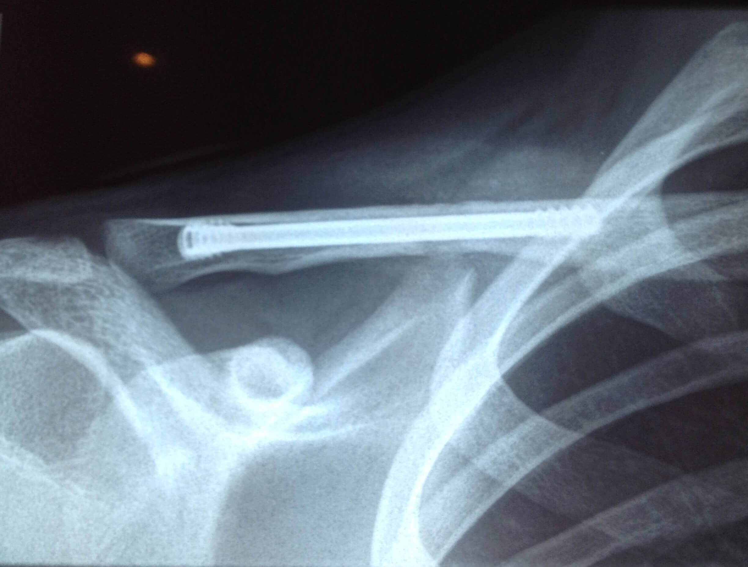 Orthopaedics Victoria Patient Information Shoulder